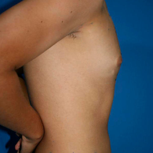 Ginecomastia (Hombre)