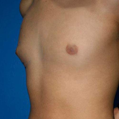 Ginecomastia (Hombre)