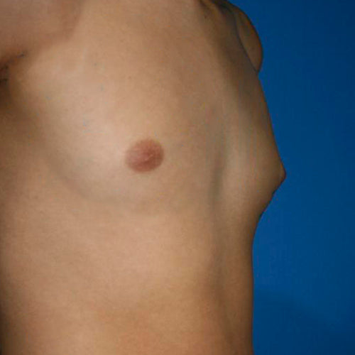 Ginecomastia (Hombre)