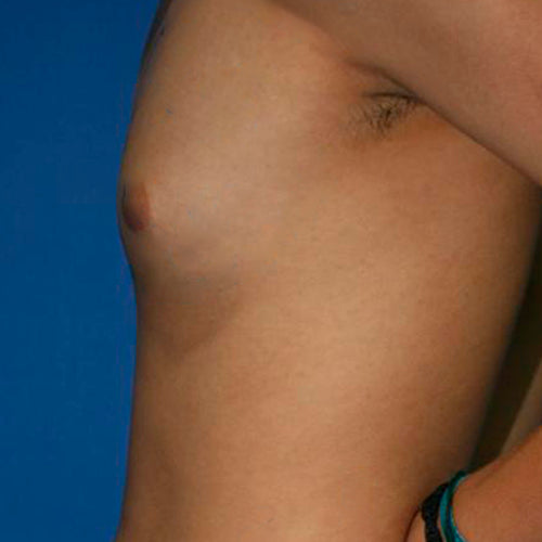 Ginecomastia (Hombre)