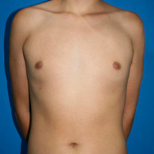 Ginecomastia (Hombre)