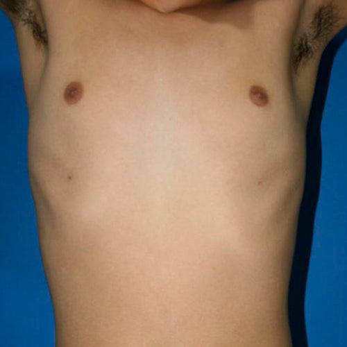 Ginecomastia (Hombre)