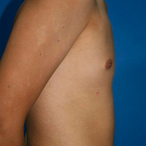 Ginecomastia (Hombre)