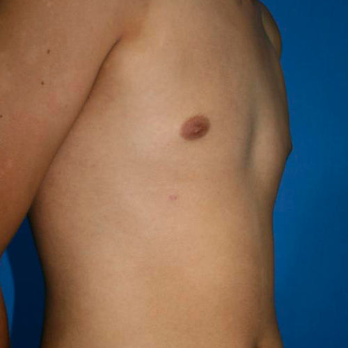 Ginecomastia (Hombre)