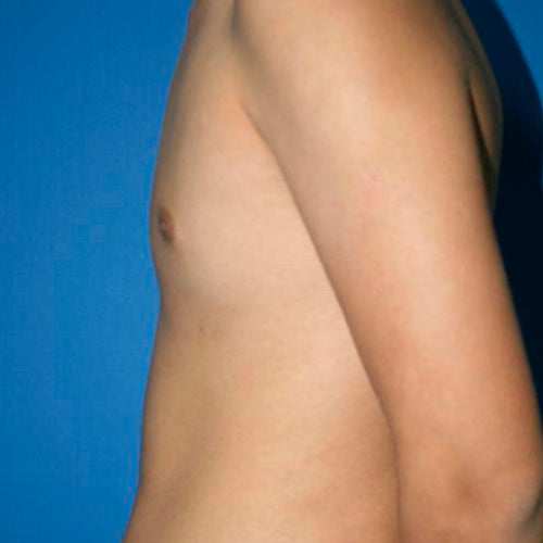 Ginecomastia (Hombre)