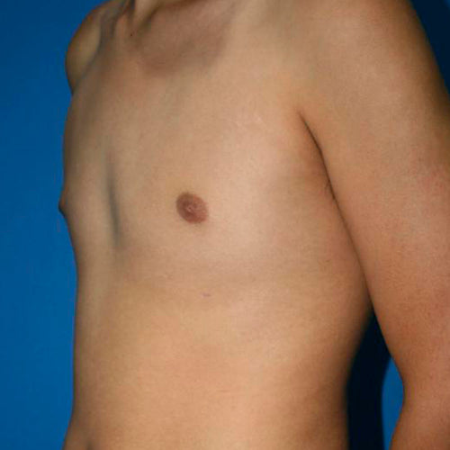 Ginecomastia (Hombre)