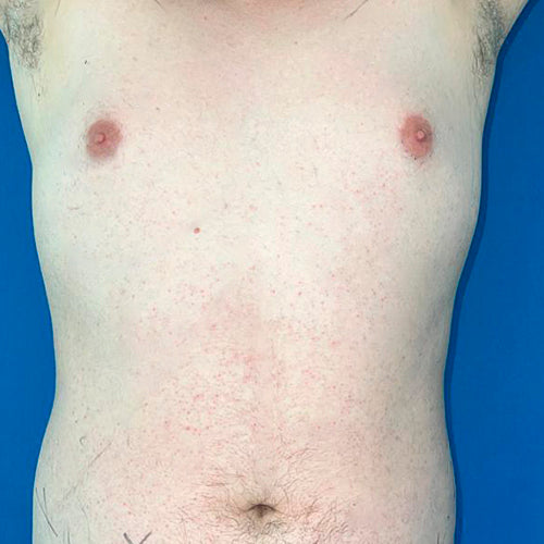 Ginecomastia (Hombre)