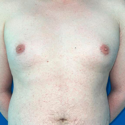 Ginecomastia (Hombre)