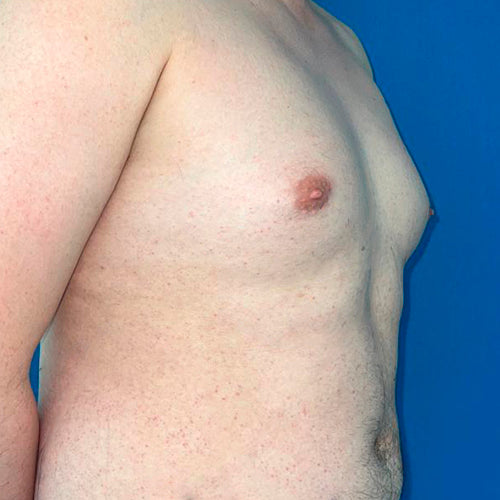 Ginecomastia (Hombre)