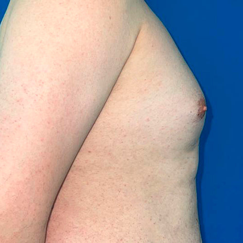 Ginecomastia (Hombre)