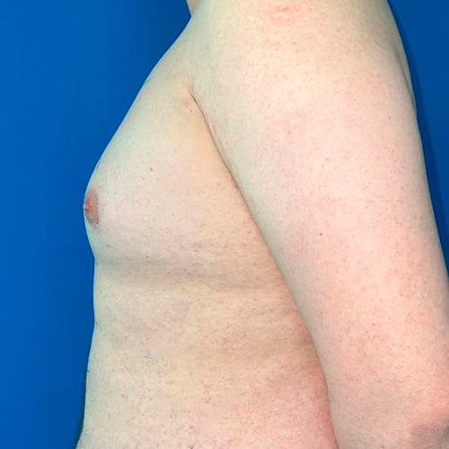 Ginecomastia (Hombre)