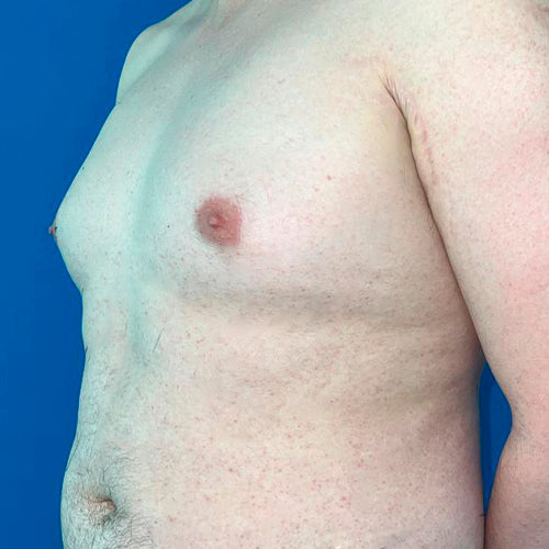 Ginecomastia (Hombre)