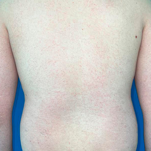 Ginecomastia (Hombre)