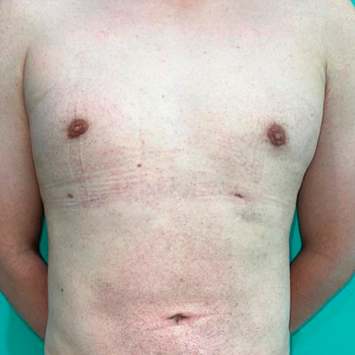 Ginecomastia (Hombre)