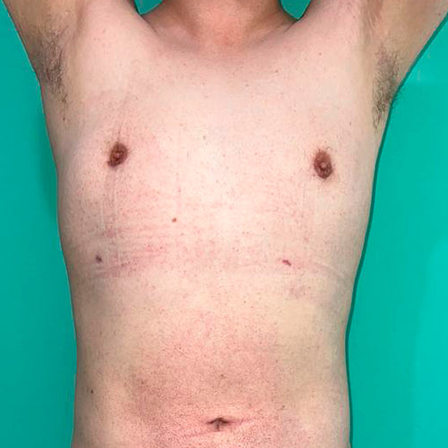 Ginecomastia (Hombre)