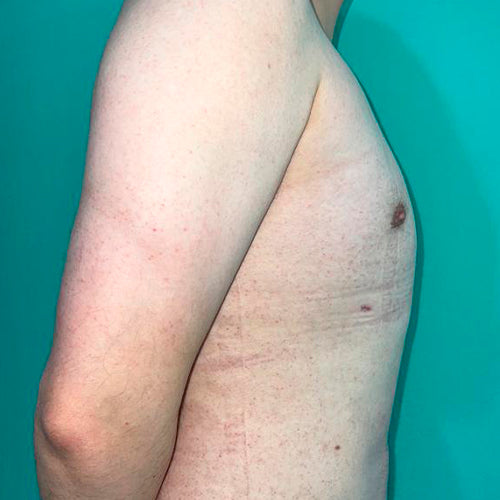 Ginecomastia (Hombre)