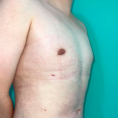 Ginecomastia (Hombre)