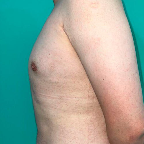 Ginecomastia (Hombre)