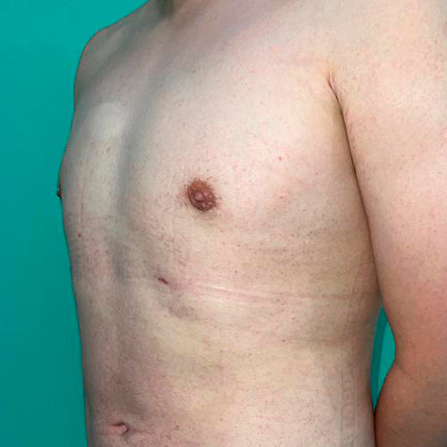 Ginecomastia (Hombre)