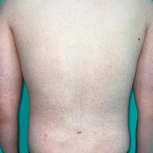 Ginecomastia (Hombre)