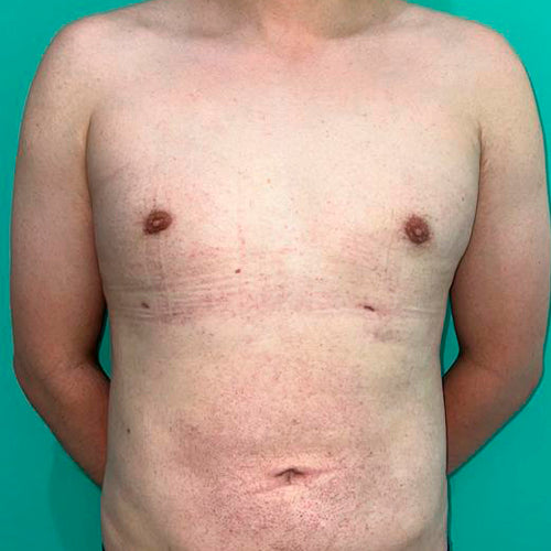 Ginecomastia (Hombre)