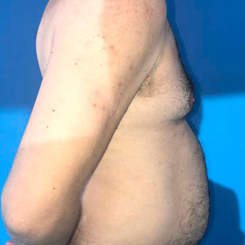 Ginecomastia (Hombre)