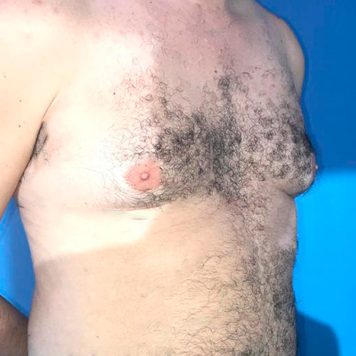 Ginecomastia (Hombre)