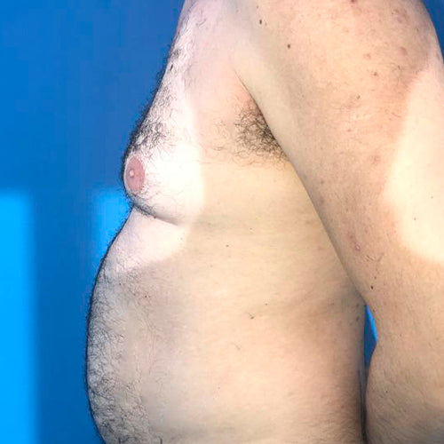 Ginecomastia (Hombre)