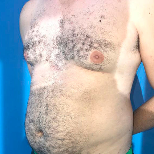 Ginecomastia (Hombre)