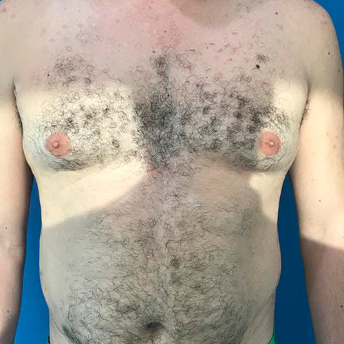 Ginecomastia (Hombre)