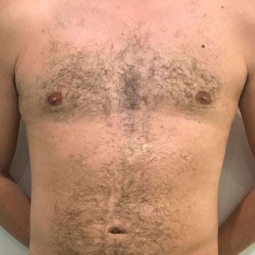 Ginecomastia (Hombre)