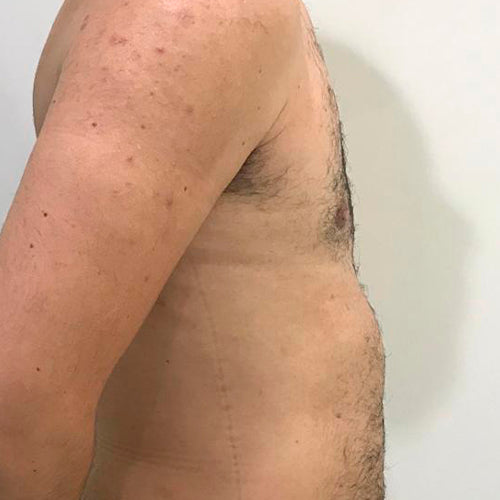 Ginecomastia (Hombre)