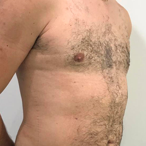 Ginecomastia (Hombre)