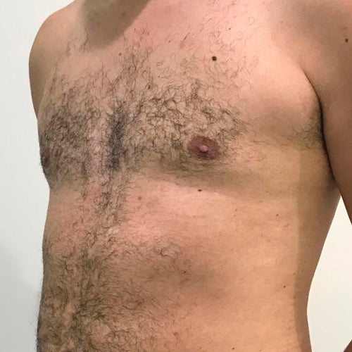 Ginecomastia (Hombre)