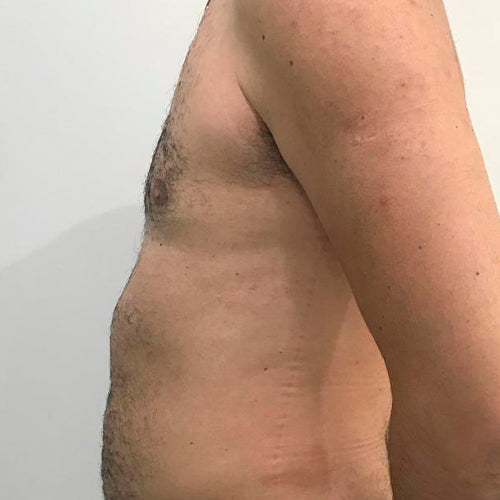 Ginecomastia (Hombre)