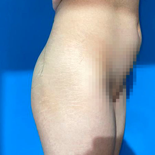 Implante de glúteos