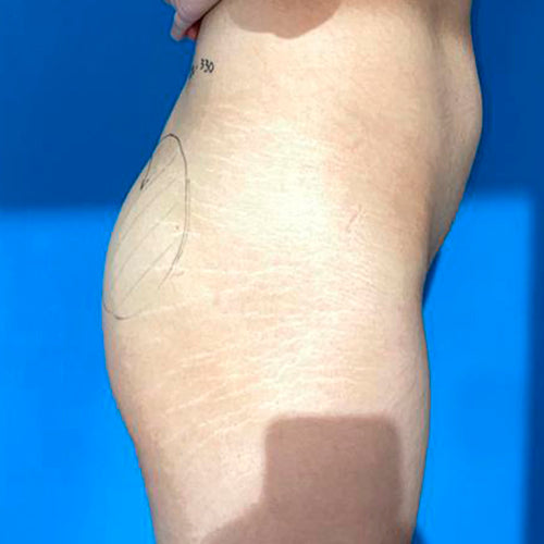 Implante de glúteos