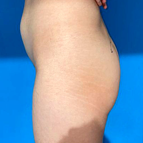 Implante de glúteos