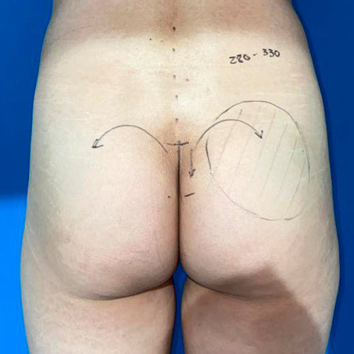 Implante de glúteos