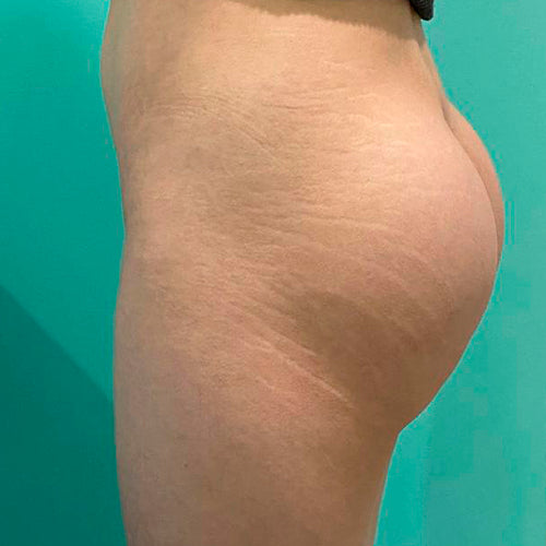 Implante de glúteos