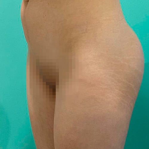 Implante de glúteos