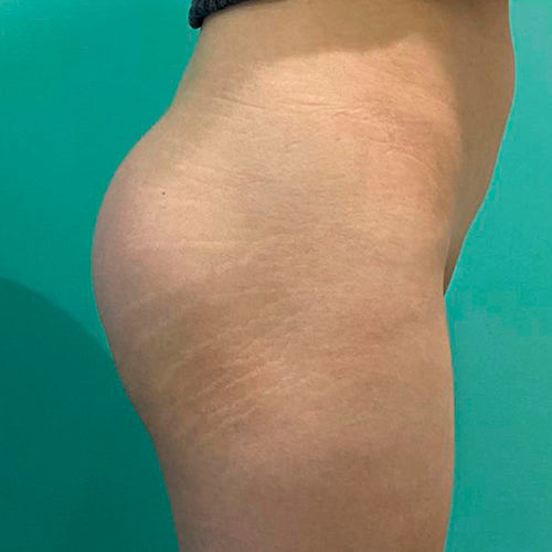 Implante de glúteos