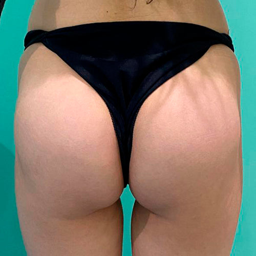 Implante de glúteos