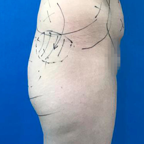 Implante de glúteos