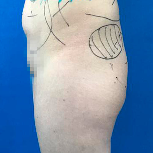 Implante de glúteos