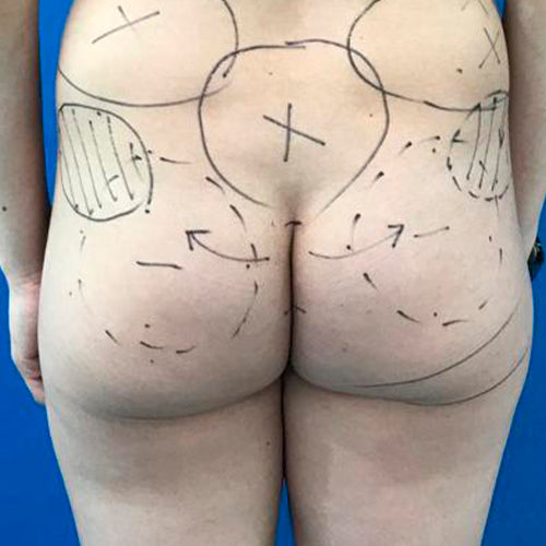 Implante de glúteos