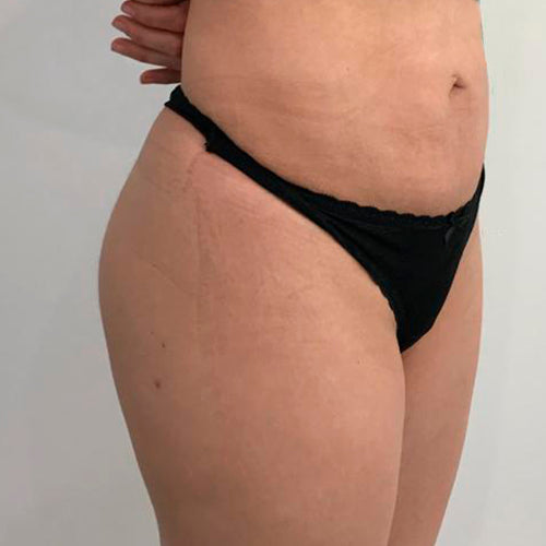 Implante de glúteos