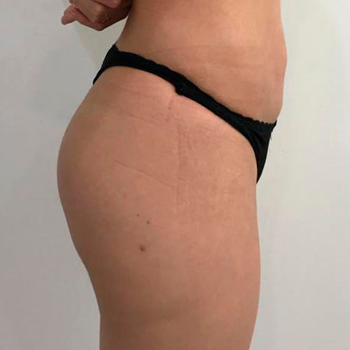 Implante de glúteos