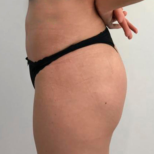 Implante de glúteos