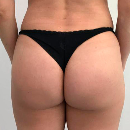 Implante de glúteos